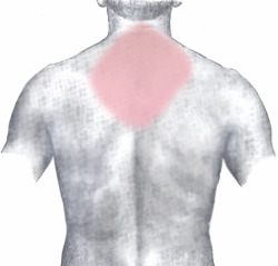 Rear view of main pain zones during an MI.